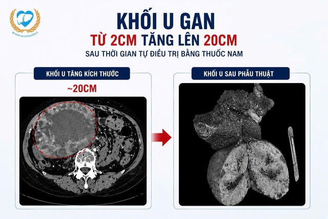 Người phụ nữ 67 tuổi ở H&agrave; Nội mang khối u gan ph&igrave;nh gấp 10 lần chỉ sau v&agrave;i th&aacute;ng d&ugrave;ng thuốc nam truyền miệng - Ảnh 1.