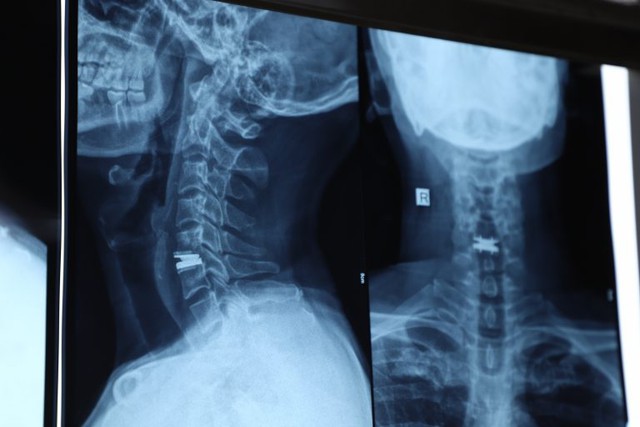 Người đ&agrave;n &ocirc;ng 43 tuổi đau cổ, t&ecirc; tay suốt 2 năm v&igrave; bệnh l&yacute; nhiều người Việt dễ bỏ qua - Ảnh 1.