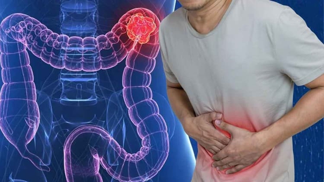 Người đ&agrave;n &ocirc;ng 45 tuổi ph&aacute;t hiện ung thư đại tr&agrave;ng di căn gan v&agrave; xương từ dấu hiệu nhiều người Việt mắc phải - Ảnh 2.