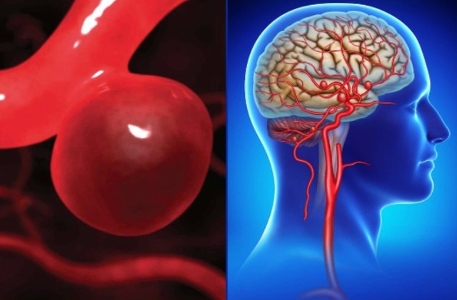 Đau đầu, buồn n&ocirc;n k&eacute;o d&agrave;i, người phụ nữ 44 tuổi bất ngờ ph&aacute;t hiện ph&igrave;nh động mạch n&atilde;o - Ảnh 2.