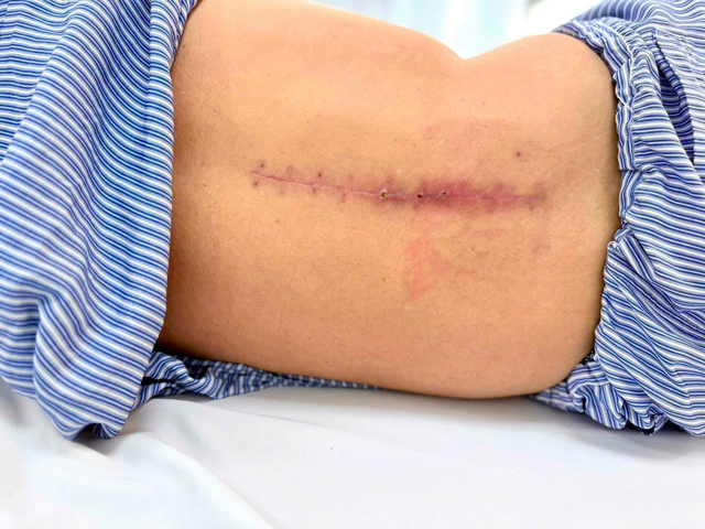 Tiếc v&agrave;i quả xo&agrave;i, người đ&agrave;n &ocirc;ng 62 tuổi su&yacute;t liệt vĩnh viễn v&igrave; chấn thương  - Ảnh 1.
