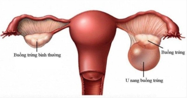 Phát hiện u buồng trứng khổng lồ sau 2 năm bỏ tái khám, người phụ nữ 68 tuổi thừa nhận sai lầm nhiều chị em mắc phải - Ảnh 1.