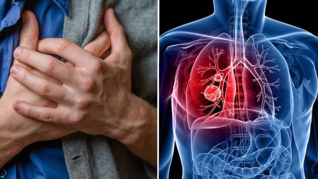 Người phụ nữ 55 tuổi bất ngờ phát hiện ung thư phổi giai đoạn sớm từ việc nhiều người Việt bỏ qua - Ảnh 2.