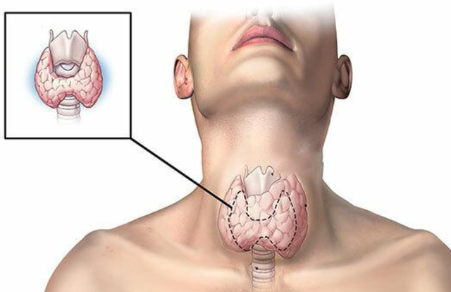 Người đ&agrave;n &ocirc;ng 46 tuổi để u tuyến gi&aacute;p lớn gấp 3 lần, thừa nhận mắc sai lầm n&agrave;y khi ph&aacute;t hiện u tuyến gi&aacute;p - Ảnh 2.