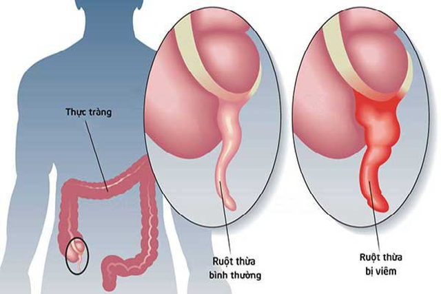 Chủ quan với đau bụng âm ỉ, người đàn ông suýt vỡ ruột thừa vì nghĩ chỉ rối loạn tiêu hóa - Ảnh 1.