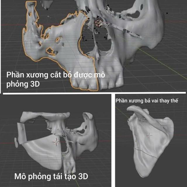 Người đ&agrave;n &ocirc;ng ph&aacute;t hiện ung thư h&agrave;m mặt sau 3 th&aacute;ng nổi u ở m&aacute;: B&aacute;c sĩ cảnh b&aacute;o dấu hiệu kh&ocirc;ng n&ecirc;n chủ quan - Ảnh 2.
