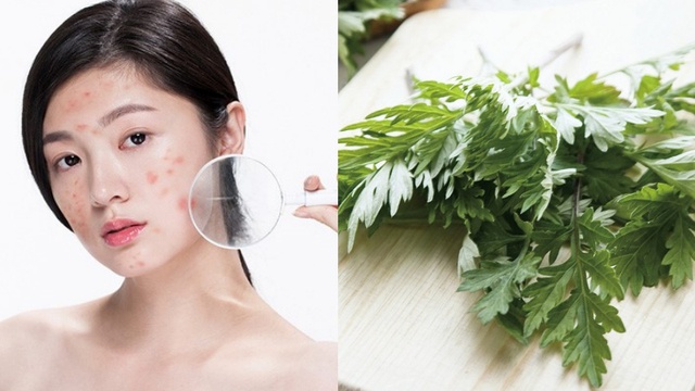 C&aacute;ch trị mụn bằng ngải cứu hiệu quả an to&agrave;n kh&ocirc;ng để lại vết th&acirc;m - Ảnh 3.