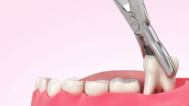 Nhổ răng khôn giá bao nhiêu? Cập nhật bảng giá và quy trình nhổ răng khôn không đau tại Nha khoa Nhân Tâm - Ảnh 1.