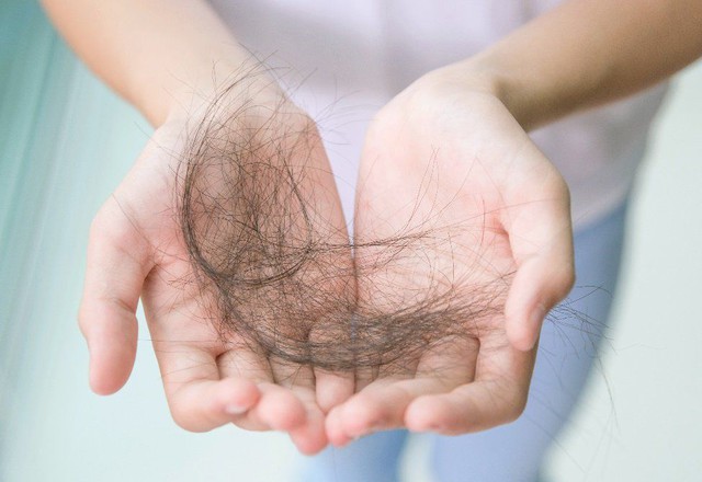 Rụng t&oacute;c mất kiểm so&aacute;t ở tuổi 20, c&ocirc; g&aacute;i đi kh&aacute;m ph&aacute;t hiện hội chứng buồng trứng đa nang - Ảnh 2.