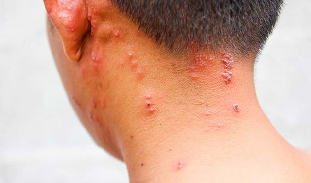 Đau đầu, nổi b&oacute;ng nước tưởng c&ocirc;n tr&ugrave;ng cắn, người đ&agrave;n &ocirc;ng su&yacute;t m&ugrave; mắt v&igrave; zona thần kinh - Ảnh 2.