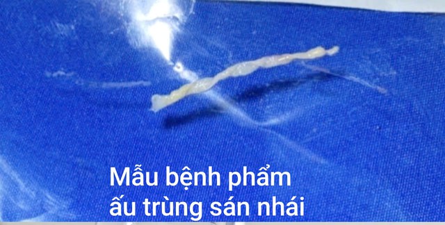 Người đàn ông Hà Nội phát hiện ấu trùng sán nhái dài 7cm ở đùi từ nguyên nhân không ngờ - Ảnh 2.
