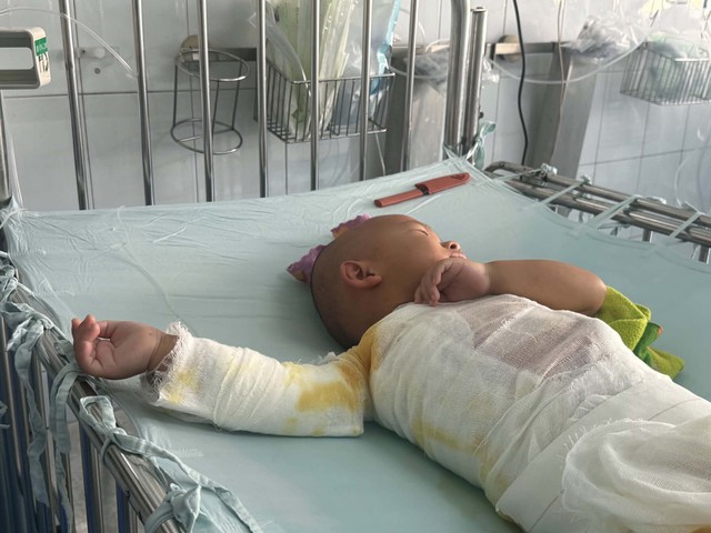 MS 1108: Bé trai dân tộc H’Mông 3 tuổi bị bỏng nặng cần sự giúp đỡ - Ảnh 4.