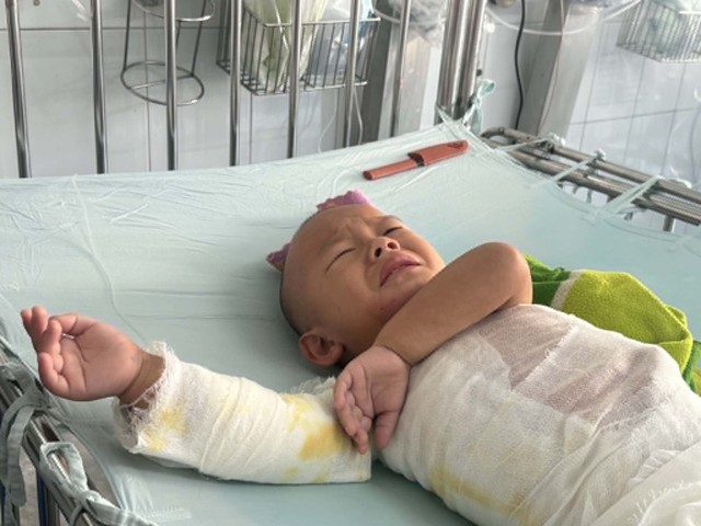 MS 1108: Bé trai dân tộc H’Mông 3 tuổi bị bỏng nặng cần sự giúp đỡ - Ảnh 2.