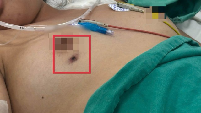 Từ vết đốt nhỏ dưới ngực, b&eacute; g&aacute;i 14 tuổi rơi v&agrave;o nguy kịch - Ảnh 2.