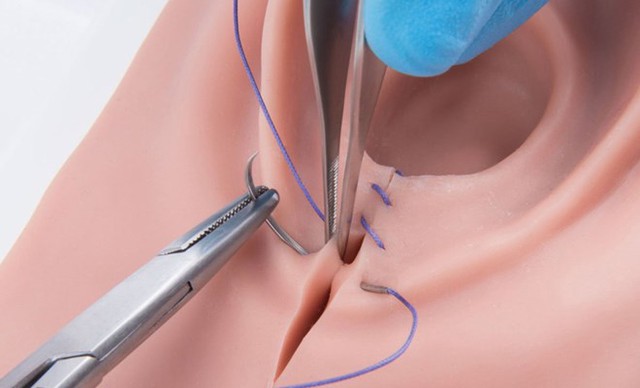 Thẩm mỹ v&ugrave;ng k&iacute;n, chị em cần biết 4 điều để tr&aacute;nh biến chứng - Ảnh 1.