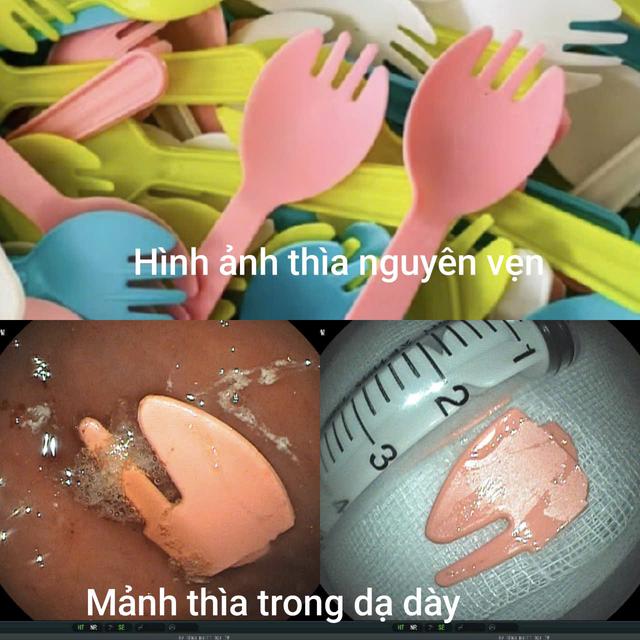 Gặp nạn khi đang ăn sữa chua, b&eacute; trai ở H&agrave; Nội phải đi cấp cứu - Ảnh 2.