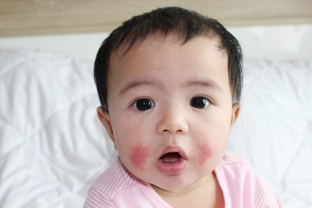 Vi&ecirc;m da ở trẻ nhỏ ảnh hưởng đến b&eacute; nhiều hơn bạn nghĩ - Ảnh 2.