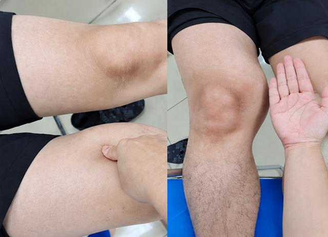 Đ&ugrave;i to bất thường nhưng kh&ocirc;ng đau, người đ&agrave;n &ocirc;ng 39 tuổi ph&aacute;t hiện ung thư m&ocirc; mềm hiếm gặp - Ảnh 1.