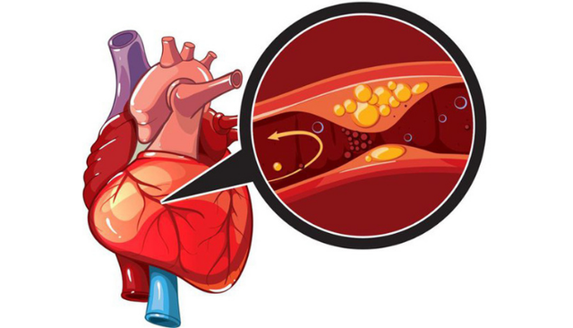 Đau ngực khi đ&aacute; b&oacute;ng, người đ&agrave;n &ocirc;ng 32 tuổi ph&aacute;t hiện nhồi m&aacute;u cơ tim - Ảnh 1.