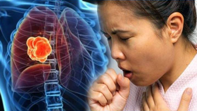 Vi&ecirc;m phổi giao m&ugrave;a tăng mạnh do th&oacute;i quen tự &yacute; d&ugrave;ng thuốc giảm ho, kh&aacute;ng sinh tại nh&agrave; - Ảnh 1.