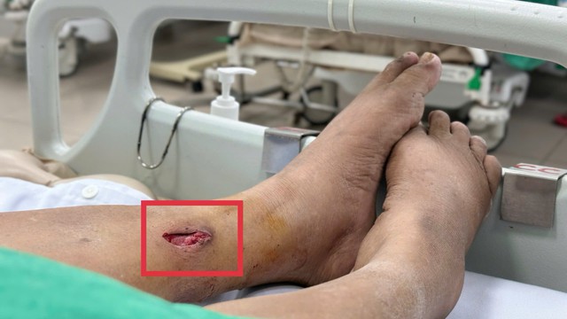 Vết thương do thanh tre đ&acirc;m v&agrave;o ch&acirc;n đ&atilde; liền, người phụ nữ 67 tuổi bất ngờ nguy kịch v&igrave; nguy&ecirc;n nh&acirc;n n&agrave;y - Ảnh 2.