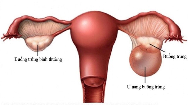U đặc buồng trứng sau m&atilde;n kinh, người phụ nữ 60 tuổi phải phẫu thuật cắt tử cung v&agrave; hai phần phụ - Ảnh 1.
