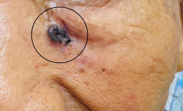 Người phụ nữ 69 tuổi tưởng vết trầy xước trên mặt, đi khám bất ngờ phát hiện ung thư da - Ảnh 1.