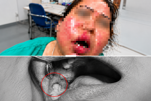 Từ đau răng đến áp xe vùng mặt: Cảnh báo nguy cơ nhiễm trùng ở người đái tháo đường - Ảnh 1.