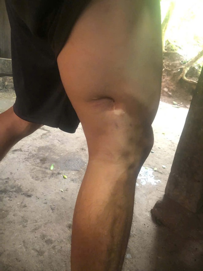 MS 1124: Một mình nuôi con trai khuyết tật, người mẹ Hà Nhì giờ mang bệnh cần chi phí phẫu thuật - Ảnh 5.
