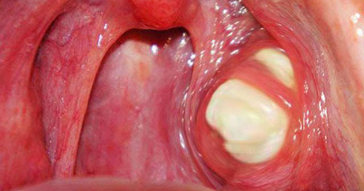Cô gái bị bạn trai chia tay vì hôi miệng, đi khám bác sĩ phát hiện điều bất ngờ