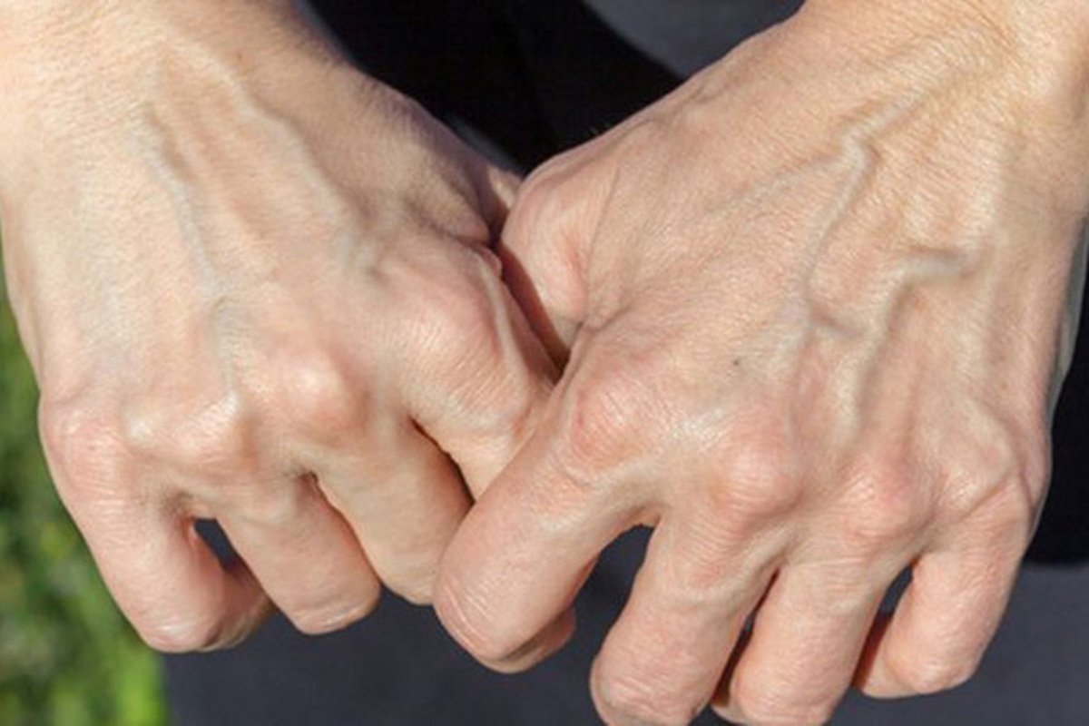 T&igrave;nh trạng nổi g&acirc;n xanh r&otilde; ở 5 vị tr&iacute; dưới đ&acirc;y cảnh b&aacute;o cơ thể ...