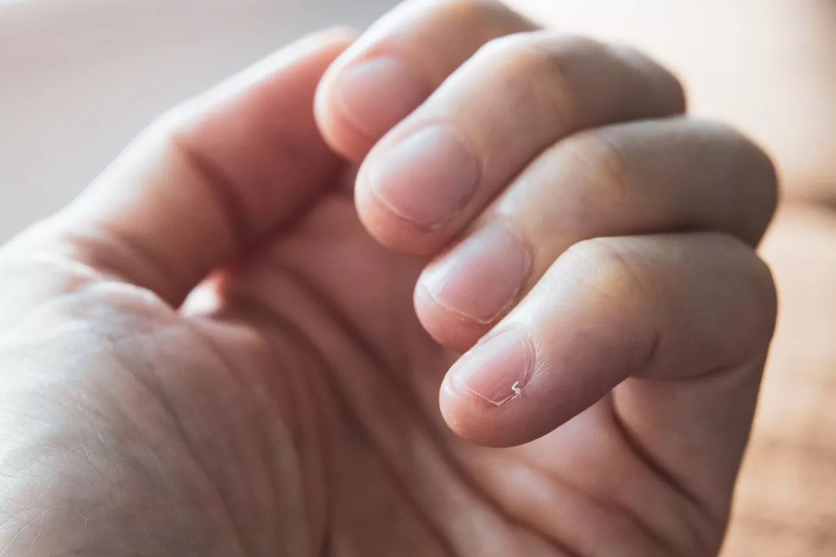 1 thay đổi nhỏ ở ng&oacute;n tay c&oacute; thể l&agrave; dấu hiệu sớm của ung thư phổi: Người  h&uacute;t thuốc l&aacute; cần kiểm tra ngay