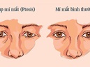 Điều trị sụp mí bằng Đông y – trẻ hóa cơ mắt, cải thiện tầm nhìn