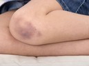 Vết bầm tím trên cơ thể, tưởng đơn giản nhưng có thể là dấu hiệu cảnh báo bệnh lý nguy hiểm