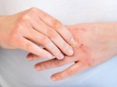 Cải thiện viêm da cơ địa (chàm, eczema) tại nhà bằng bộ đôi từ thiên nhiên