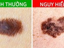Các dấu hiệu cảnh báo ung thư đang xảy ra trên nốt ruồi trước đây là nốt ruồi lành tính
