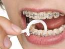 Điểm danh những tác hại của niềng răng có thể bạn chưa biết