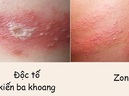 Da biến chứng nặng vì nhầm lẫn kiến ba khoang cắn thành zona thần kinh