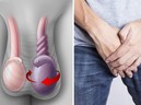 Từ vụ bé 12 tuổi bị xoắn tinh hoàn, bác sĩ khuyến cáo đừng bỏ lỡ "giai đoạn vàng" của trẻ