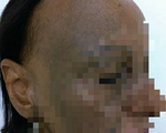 Người phụ nữ ở TP.HCM mắc bệnh lạ, đột nhiên rụng tóc, hói nửa đầu
