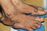 Hỏi và đáp về bệnh gút Hỏi và đáp về bệnh gút