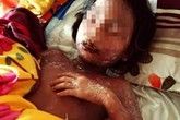 Phồng rộp toàn thân sau khi uống nước ngọt Phồng rộp toàn thân sau khi uống nước ngọt