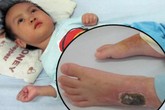 Đau đớn cảnh bé 28 tháng tuổi bất động vì lao màng não Đau đớn cảnh bé 28 tháng tuổi bất động vì lao màng não
