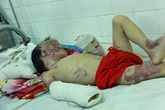 Vòng tay nhân ái (MS 135): Hoàn cảnh thương tâm của cháu bé bị bỏng làm biến dạng mặt Vòng tay nhân ái (MS 135): Hoàn cảnh thương tâm của cháu bé bị bỏng làm biến dạng mặt