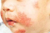 Làm cách nào để phòng ngừa dị ứng cho trẻ? Làm cách nào để phòng ngừa dị ứng cho trẻ?