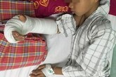 Nối bàn tay bị đứt gần lìa cho bé trai 8 tuổi Nối bàn tay bị đứt gần lìa cho bé trai 8 tuổi