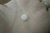 Mẹ hốt hoảng phát hiện hạt cườm trong hốc mũi con sau khi đi mẫu giáo về Mẹ hốt hoảng phát hiện hạt cườm trong hốc mũi con sau khi đi mẫu giáo về