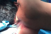 Ngáo đá dùng kéo đâm xuyên phổi nạn nhân Ngáo đá dùng kéo đâm xuyên phổi nạn nhân