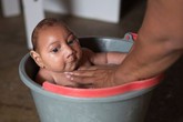 Virus Zika gây dị tật đầu nhỏ ở trẻ đã xâm nhập hàng chục nước Virus Zika gây dị tật đầu nhỏ ở trẻ đã xâm nhập hàng chục nước