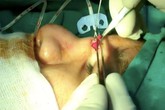 Sau 2 năm thiếu nữ nâng mũi, BS kinh ngạc gắp ra cục gạc Sau 2 năm thiếu nữ nâng mũi, BS kinh ngạc gắp ra cục gạc